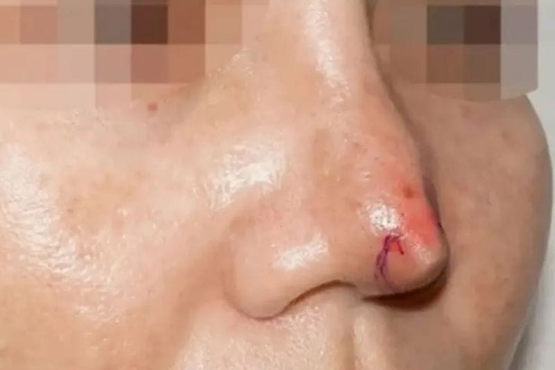 Tụt sụn mũi khá nguy hiểm nếu không xử lý kịp thời