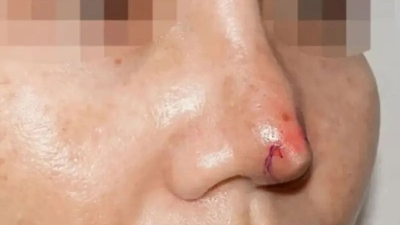 Tụt sụn mũi: Dấu hiệu, nguyên nhân và cách khắc phục