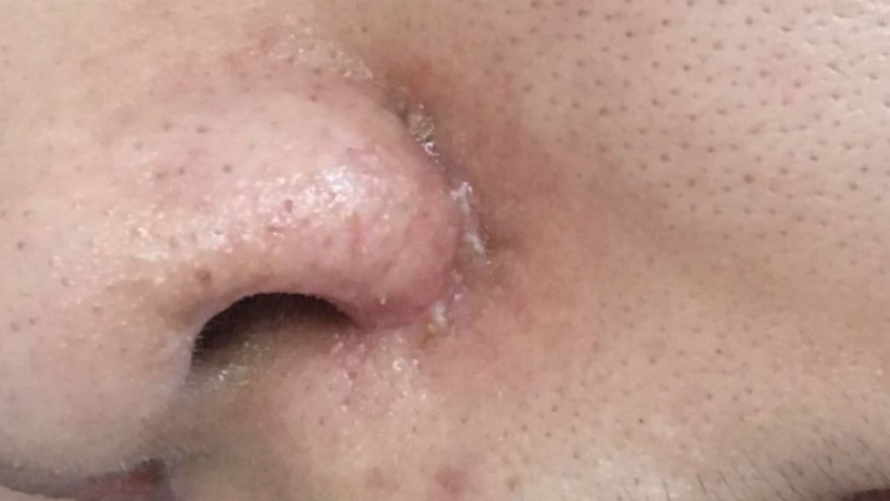 Vết khâu nâng mũi đóng vảy có phải dấu hiệu hồi phục bình thường?