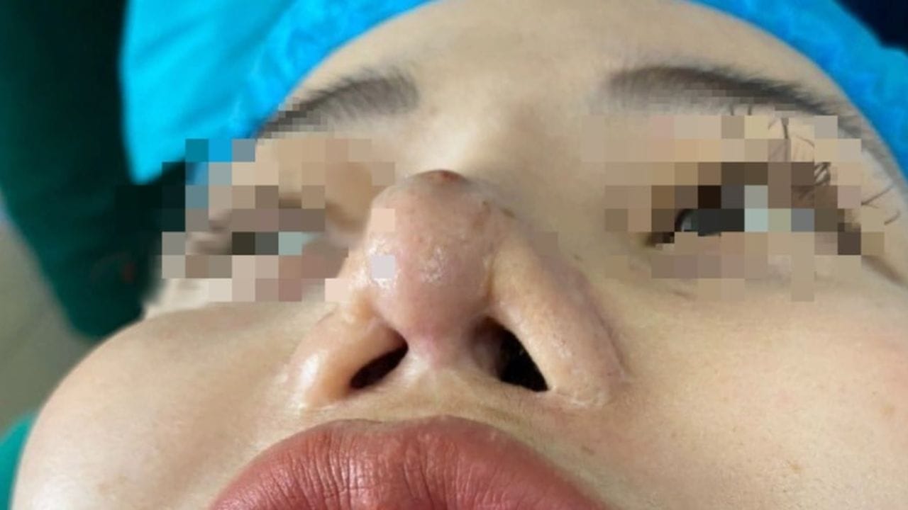 7 Biến chứng nâng mũi sụn sườn có thể gặp? Cách phòng tránh biến chứng