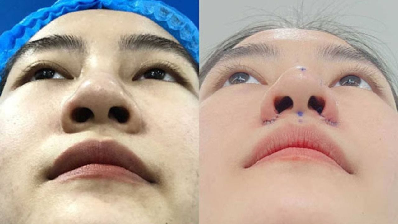 Cắt cánh mũi có mất lộc không? Đối tượng phù hợp để cắt cánh mũi