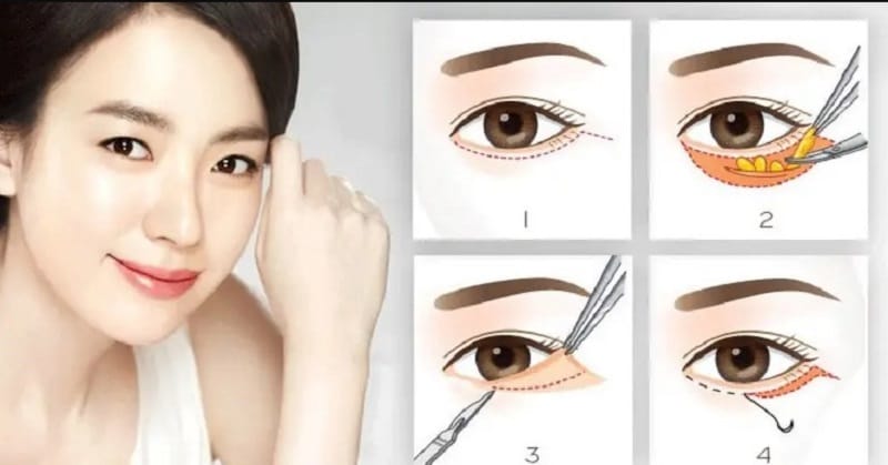 Chi phí cắt da thừa mí mắt phụ thuộc vào nhiều yếu tố