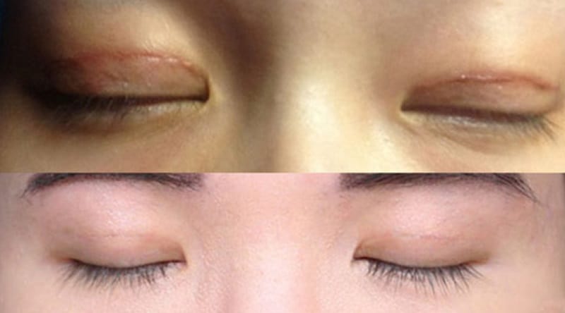 Mí mắt để lại sẹo do nhiều nguyên nhân gây nên