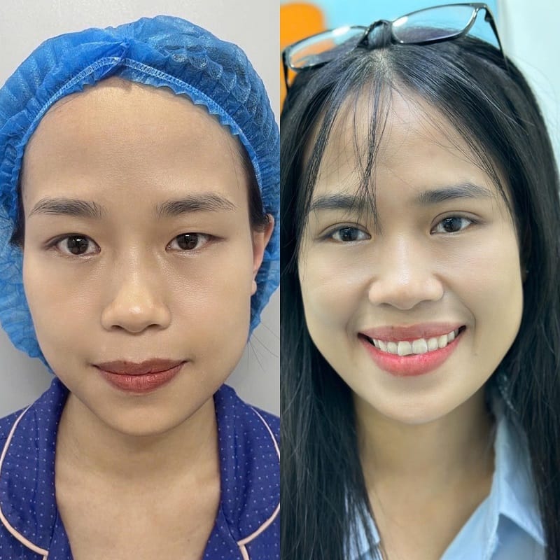 Tại Kangnam ứng dụng cắt mí bằng công nghệ Hàn Quốc, sử dụng chỉ khâu thẩm mỹ nên không để lại sẹo xấu