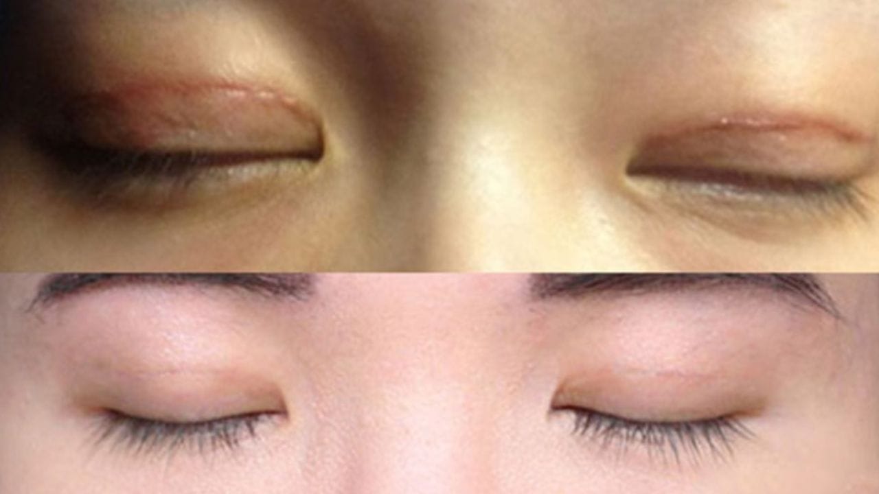 Cắt mí bị sẹo lồi phải làm sao? 7 cách khắc phục hiệu quả