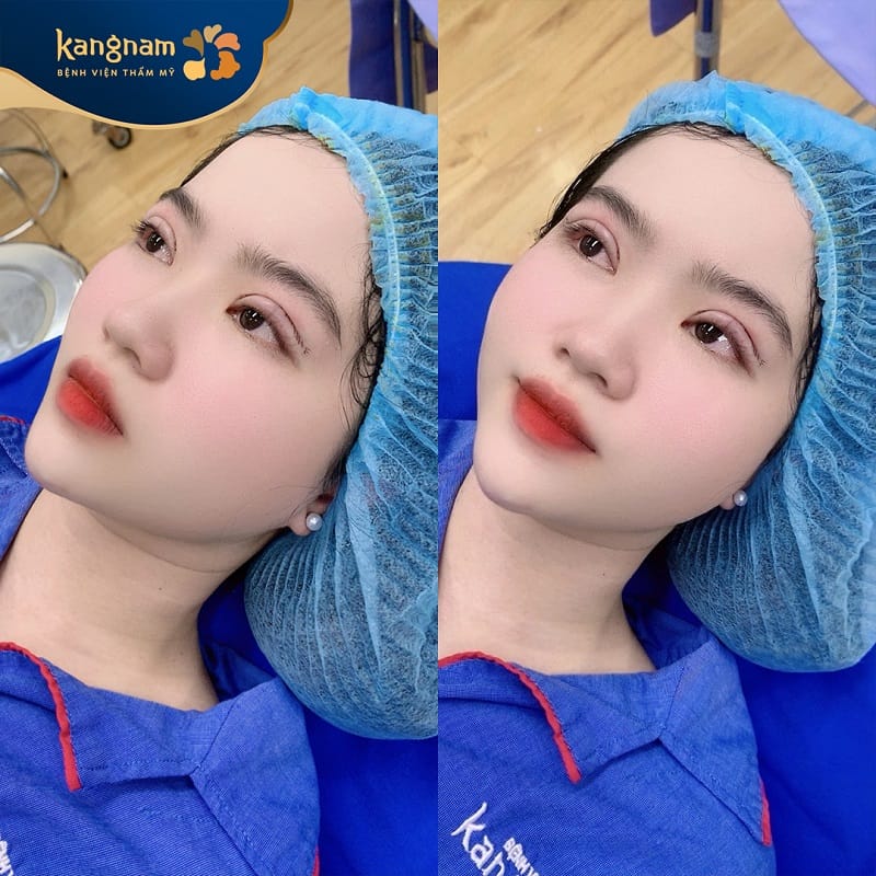 Khách hàng có thể ra về sau cắt mí, chỉ có một số trường hợp đặc biệt cần phải ở lại viện