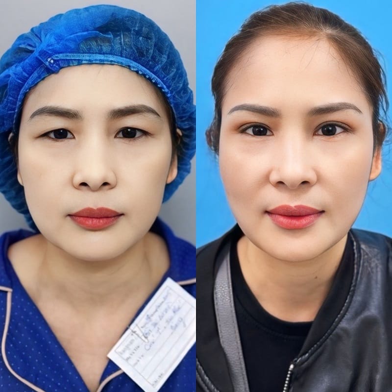 Những trường hợp mắt 1 mí, mắt mí lót, sụp mí nên cắt mí