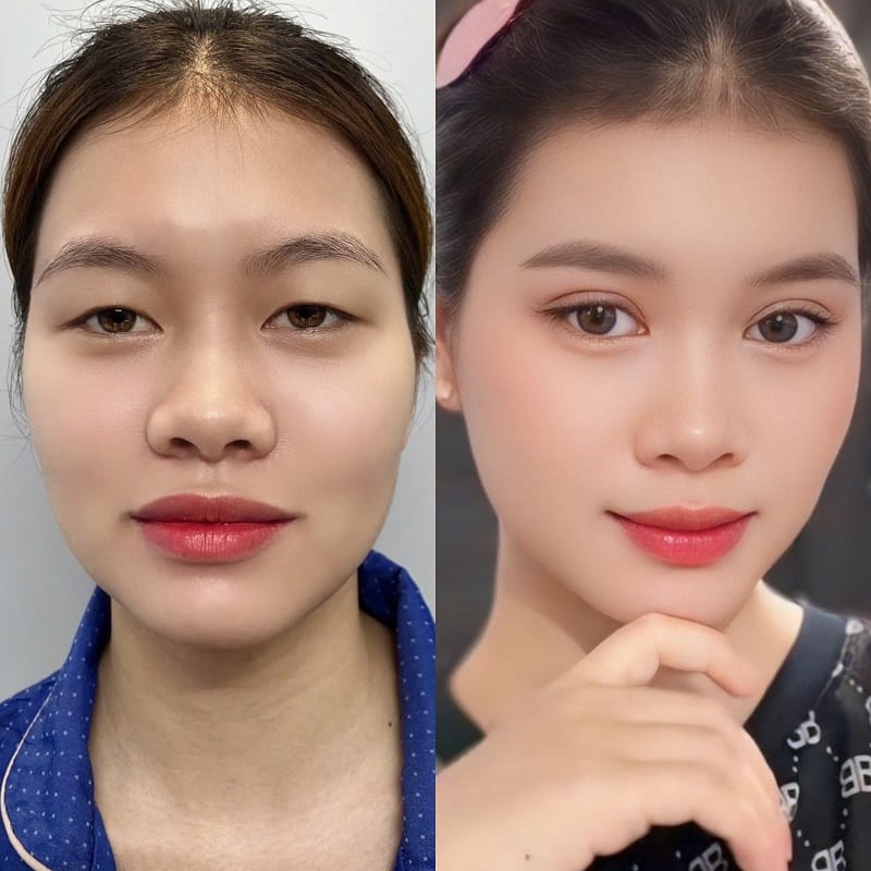 Cắt mí giúp gương mặt tươi trẻ hơn