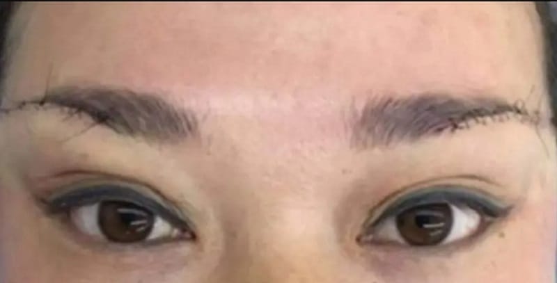 Mí mắt bị trợn gây ảnh hưởng đến tính thẩm mỹ