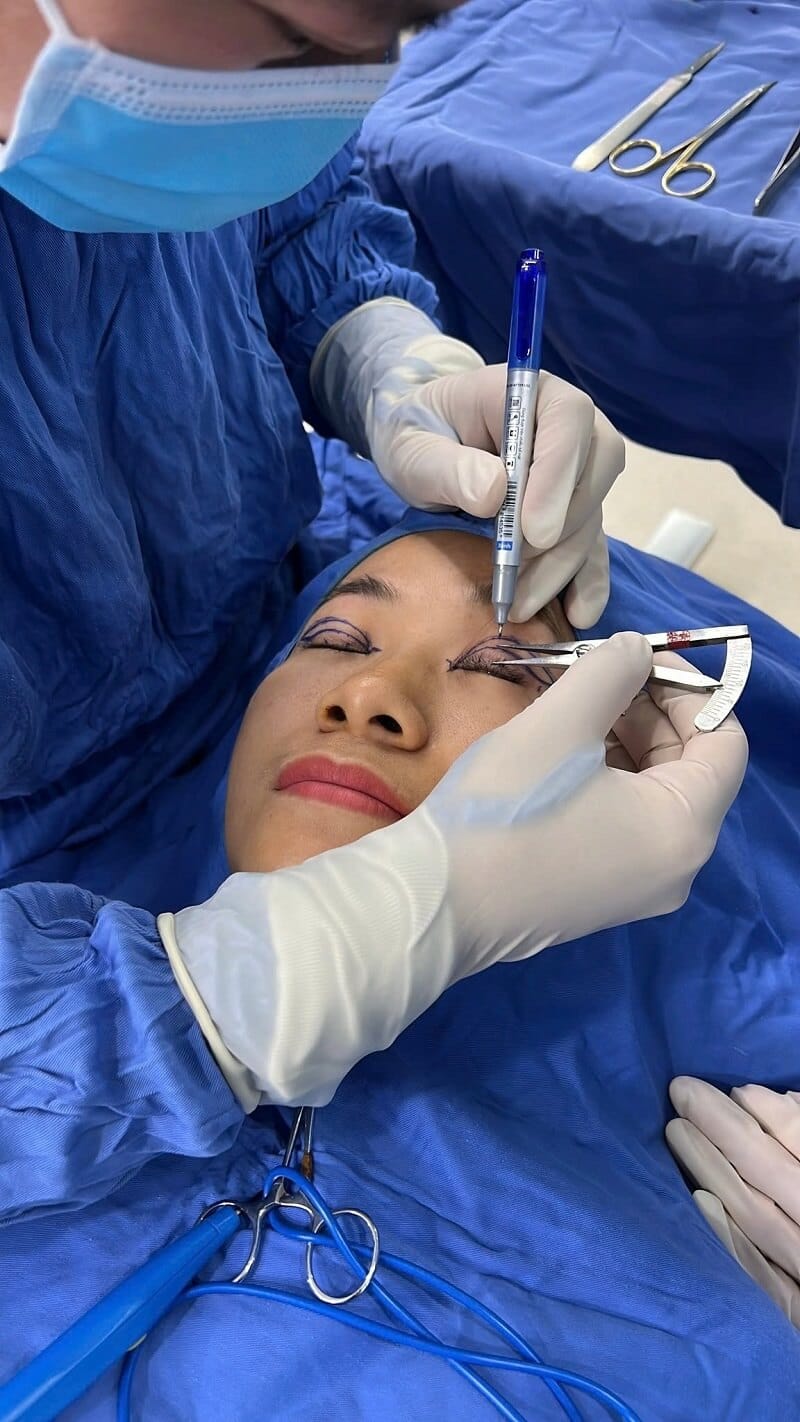 Nếu bác sĩ lấy quá nhiều da dư và mỡ thừa có thể khiến mí mắt bị trợn 