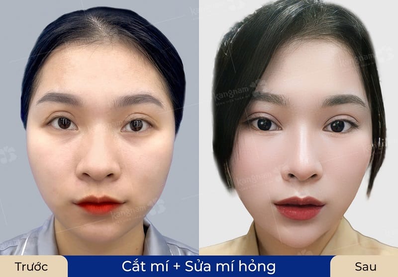 Một số trường hợp sửa mí bị trợn giúp hai mí cân đối và hài hòa hơn