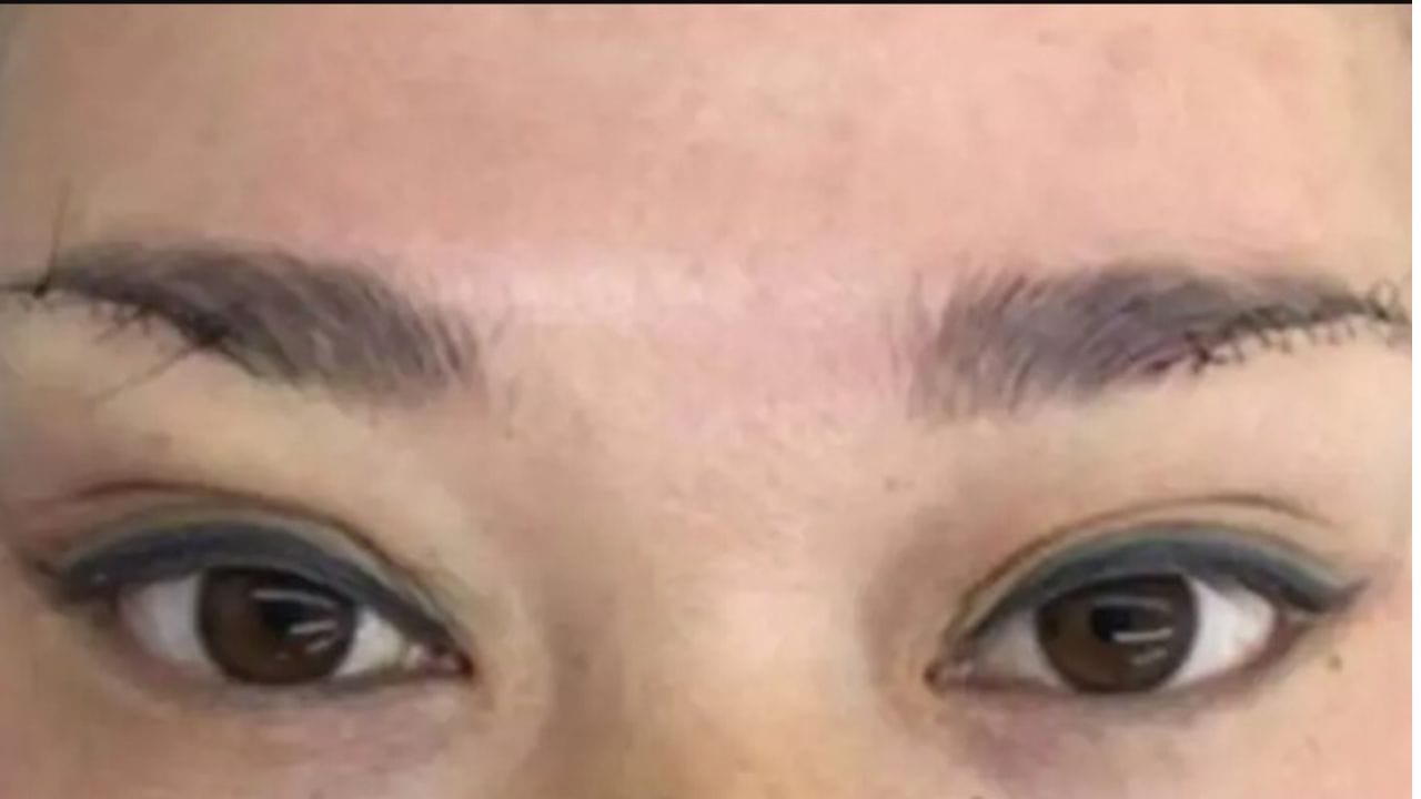 Cắt mí mắt bị trợn: Nguyên nhân, hậu quả và cách khắc phục hiệu quả