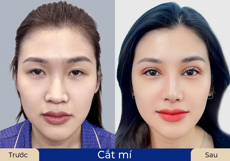 Mí mắt khách hàng cân đối, hài hòa với khuôn mặt