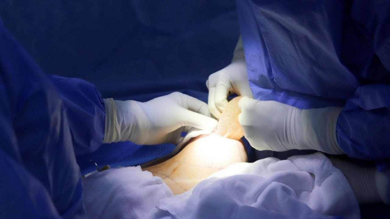 Đặt túi ngực có đau không? Cách giảm đau và nhanh hồi phục sau nâng ngực