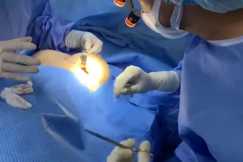 Đặt túi ngực không đau