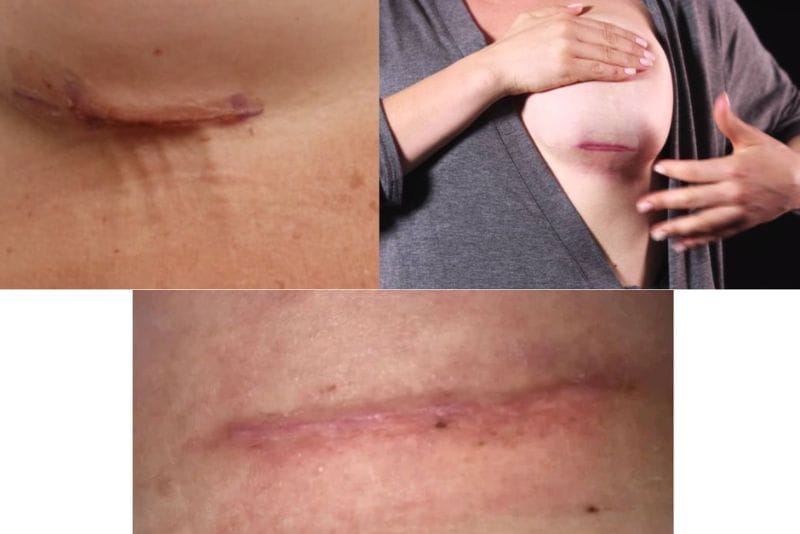 Sẹo sau nâng ngực do bác sĩ thao tác sai