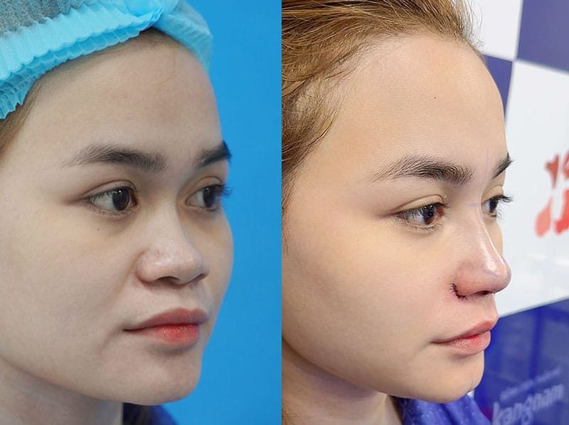 Việt Kiều Úc sở hữu mũi cao, thẳng sau phẫu thuật