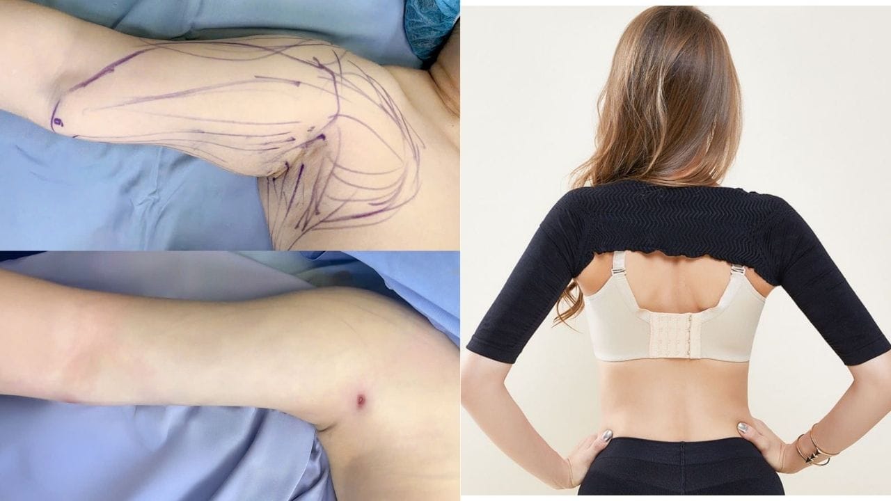 Hút mỡ bắp tay bao lâu thì lành? Cách chăm sóc để bắp tay nhanh hồi phục