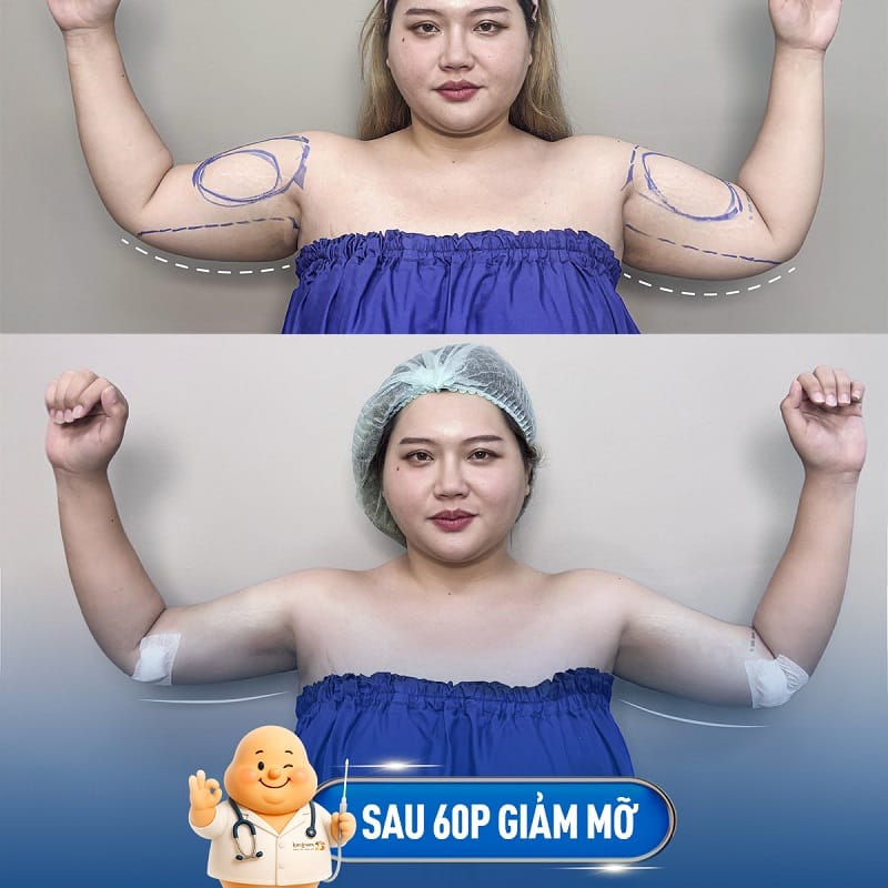 Giảm mỡ bắp tay giúp phái đẹp tự tin hơn