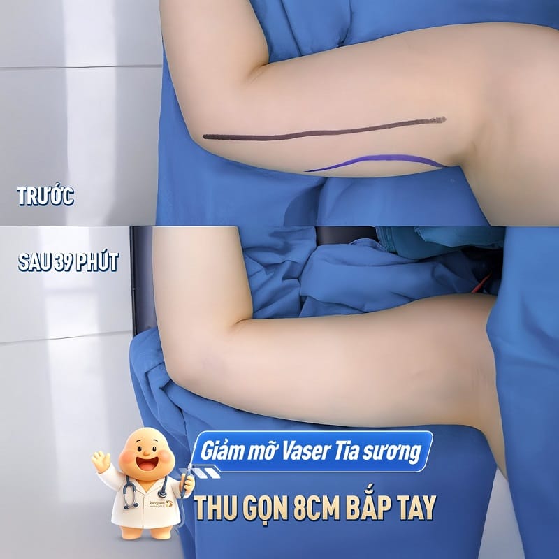 Tại Kangnam khách hàng có thể nhanh chóng sở hữu cánh tay thon gọn, đảm bảo an toàn