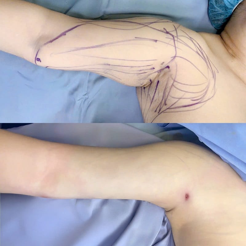 Hút mỡ bắp tay giúp loại bỏ mỡ thừa hiệu quả khi thực hiện đúng quy trình