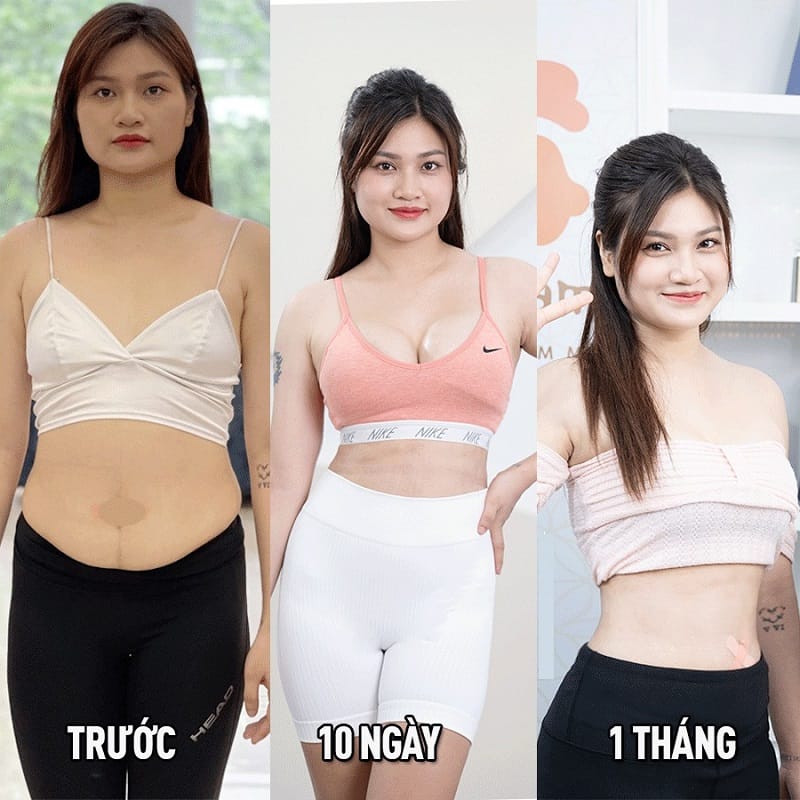 Hút mỡ bụng sẽ đẹp tự nhiên vào form sau một thời gian