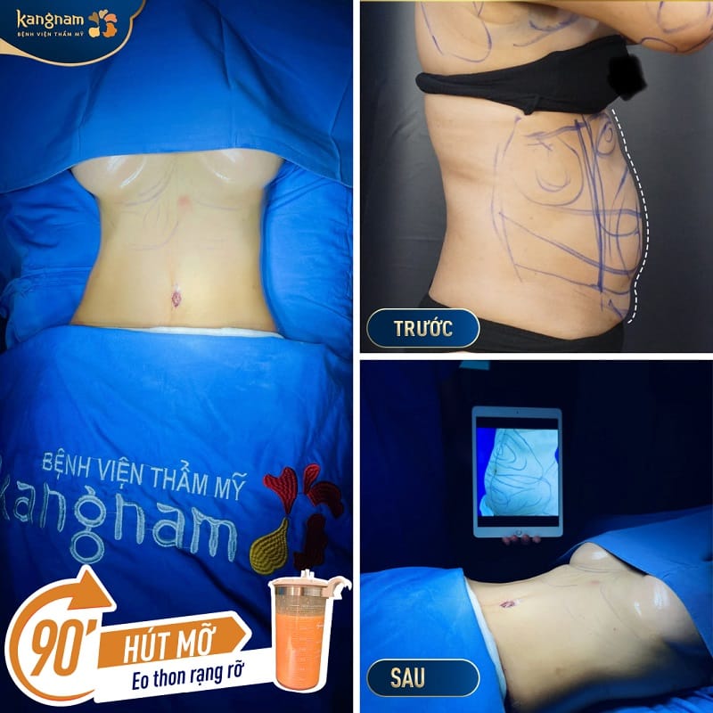 Thời gian phục hồi diễn ra theo từng giai đoạn