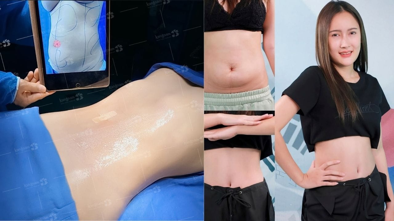 Hút mỡ bụng bao lâu thì đẹp? Thời gian phục hồi cụ thể