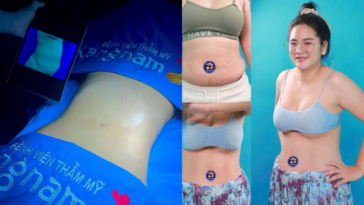 Hút mỡ bụng Vaser Lipo bao lâu thì hồi phục