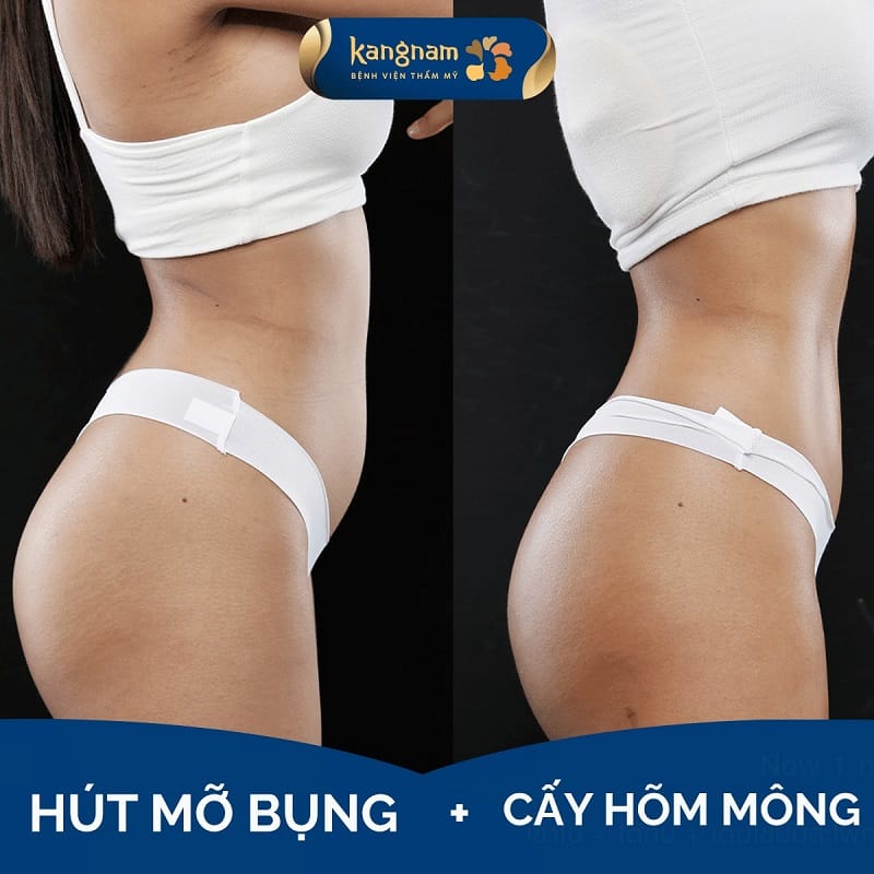 Hút mỡ bụng cấy mông giúp tạo hình vóc dáng cân đối, quyến rũ