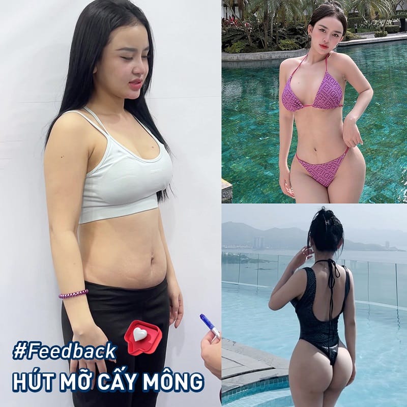 Khách hàng sở hữ vóc dáng sexy, quyến rũ sau khi hút mỡ bụng cấy mông