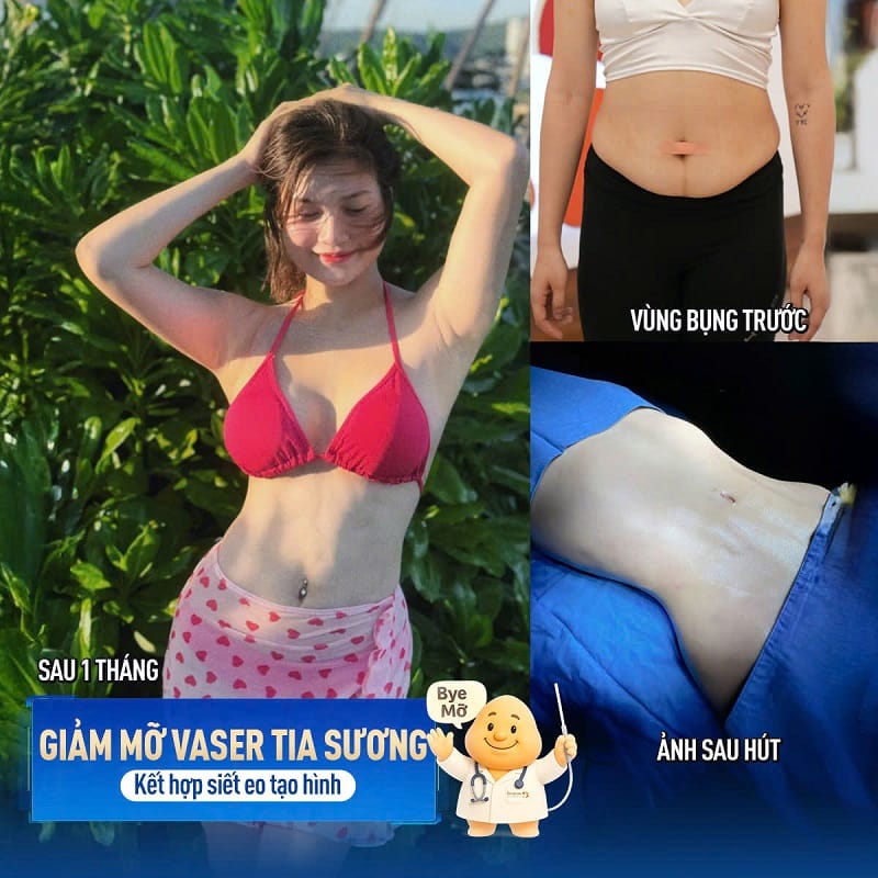 Khách hàng sở hữu vóc dáng thon gọn, nuột nà sau hút mỡ