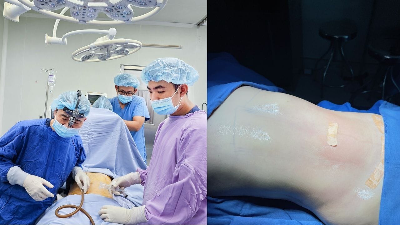 Hút mỡ bụng có đau không? 4 cách giảm đau hiệu quả