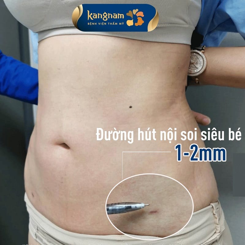 Vết sẹo hút mỡ siêu nhỏ và sẽ mờ dần theo thời gian