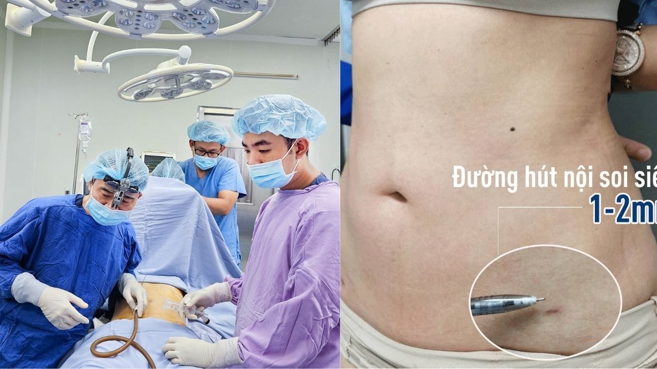 Hút mỡ có để lại sẹo không? Cách phòng tránh sau hút mỡ