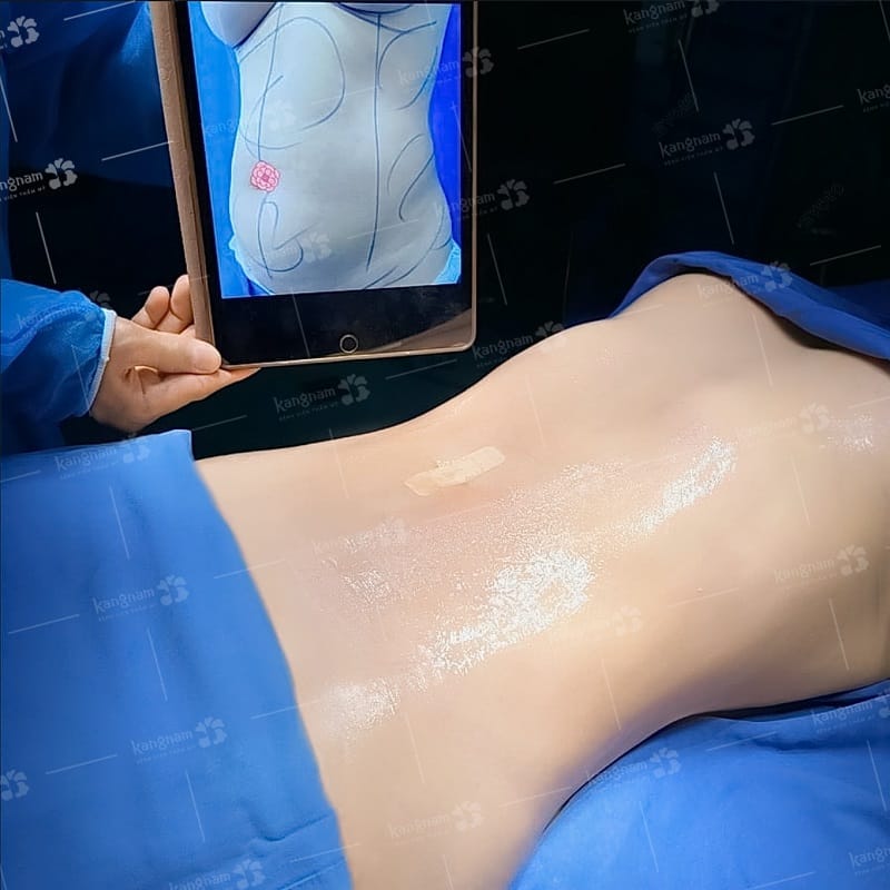 Hút mỡ đúng quy trình sẽ đảm bảo an toàn cho sức khỏe