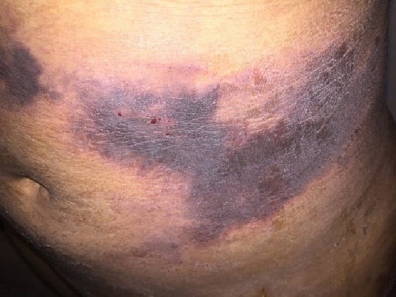 Hút mỡ sai kỹ thuật gây bầm tím, tụ dịch, hoại tử ở vùng thực hiện