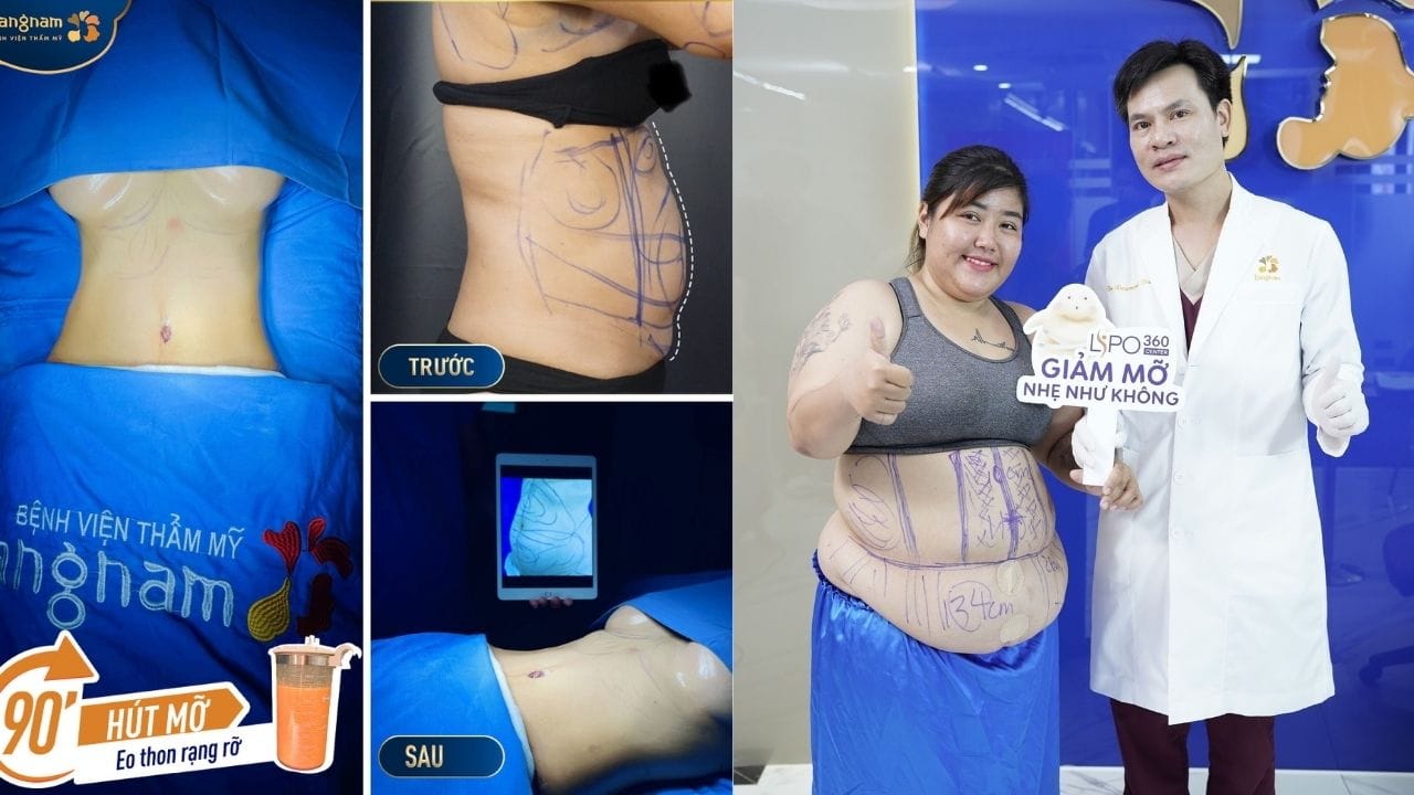 Hút mỡ bụng giảm được bao nhiêu kg – Chuyên gia giải đáp