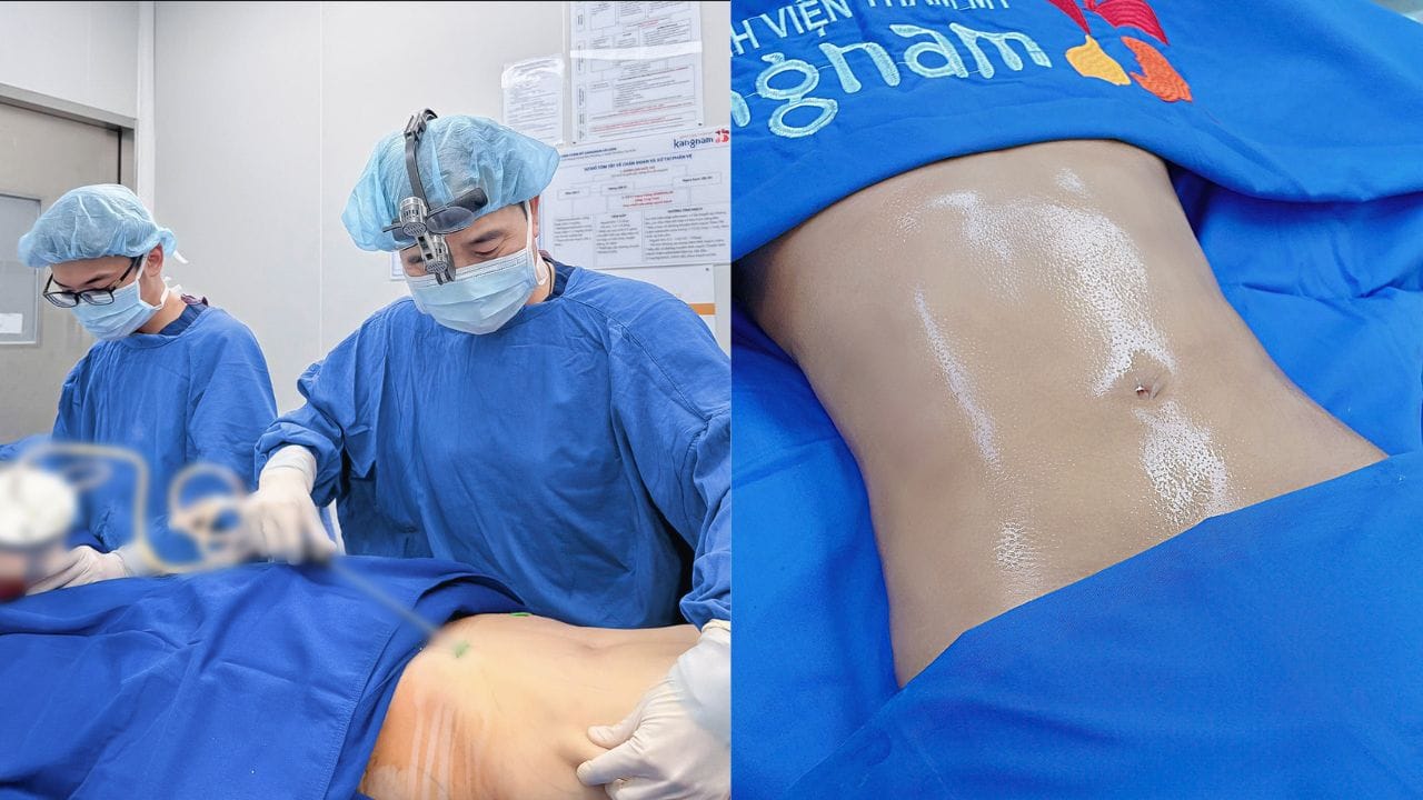 Tổng hợp 8 phương pháp hút mỡ bụng không cần phẫu thuật