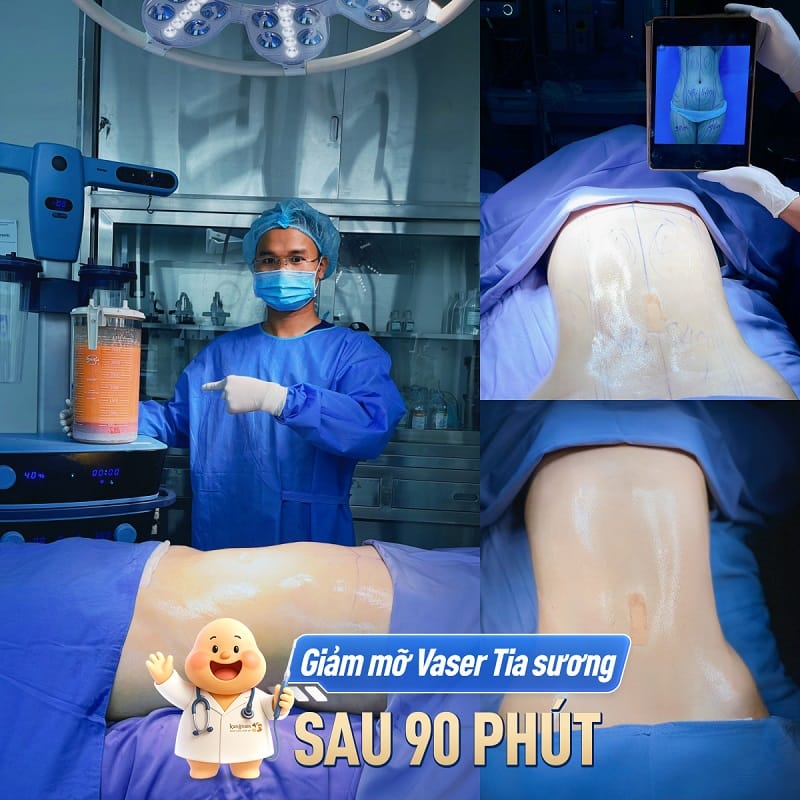Giảm mỡ Vaser tia sương, đánh bay mỡ thừa chỉ sau khoảng 90 phút