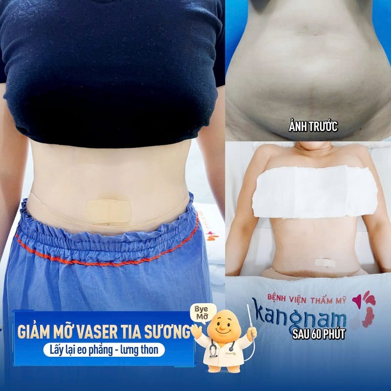 Lấy lại vòng eo thon gọn chỉ sau 1 lần hút mỡ