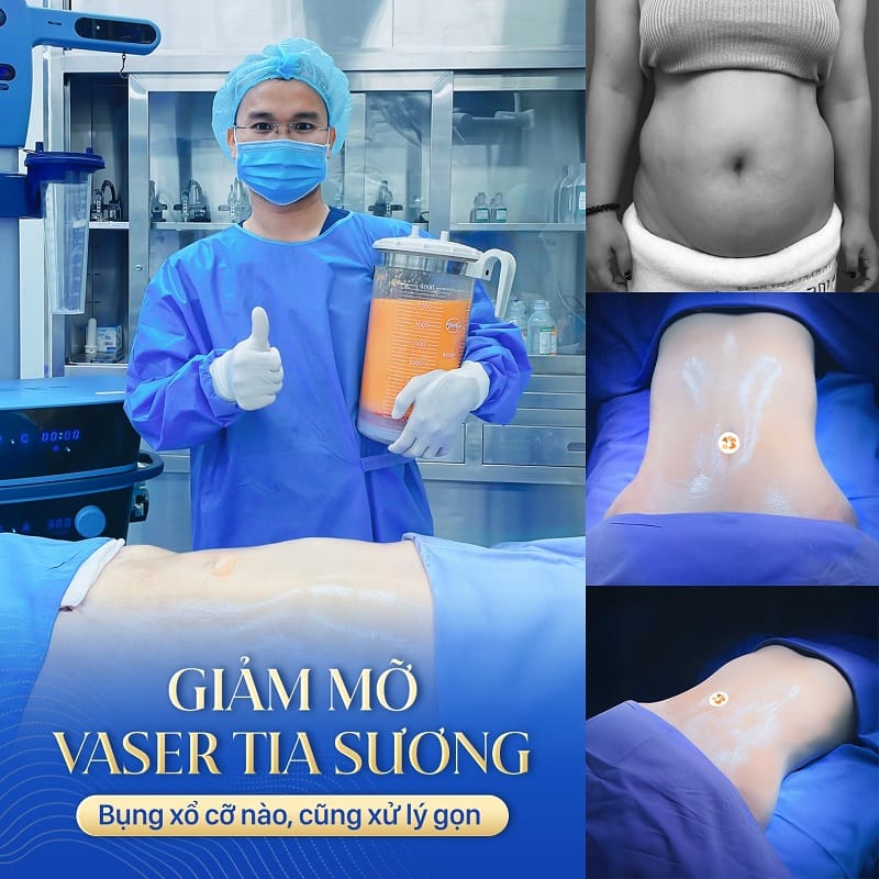 Công giảm mỡ vaser tia sương hút sạch mỡ