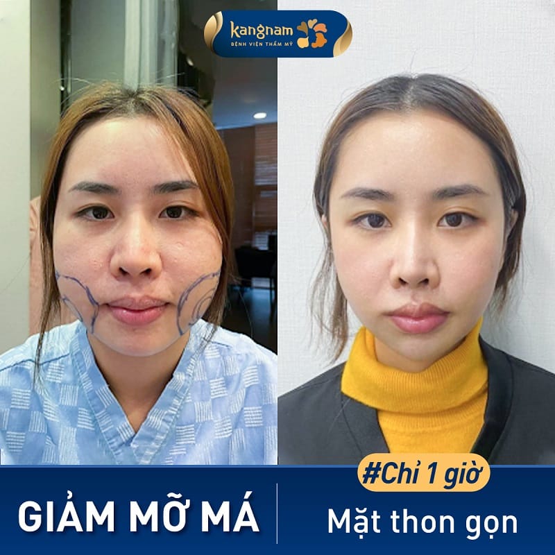 Sở hữu gương mặt vline chỉ sau 1 lần hút mỡ