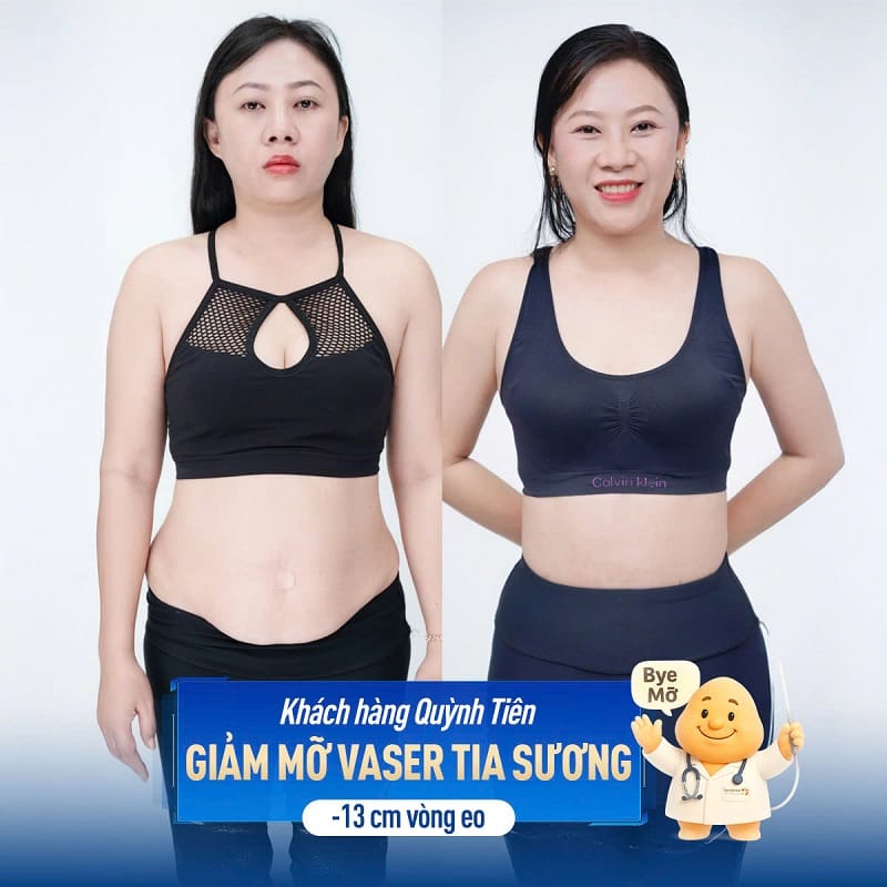 Khách hàng nên chọn cơ sở thẩm mỹ ứng dụng công nghệ hút mỡ hiện đại