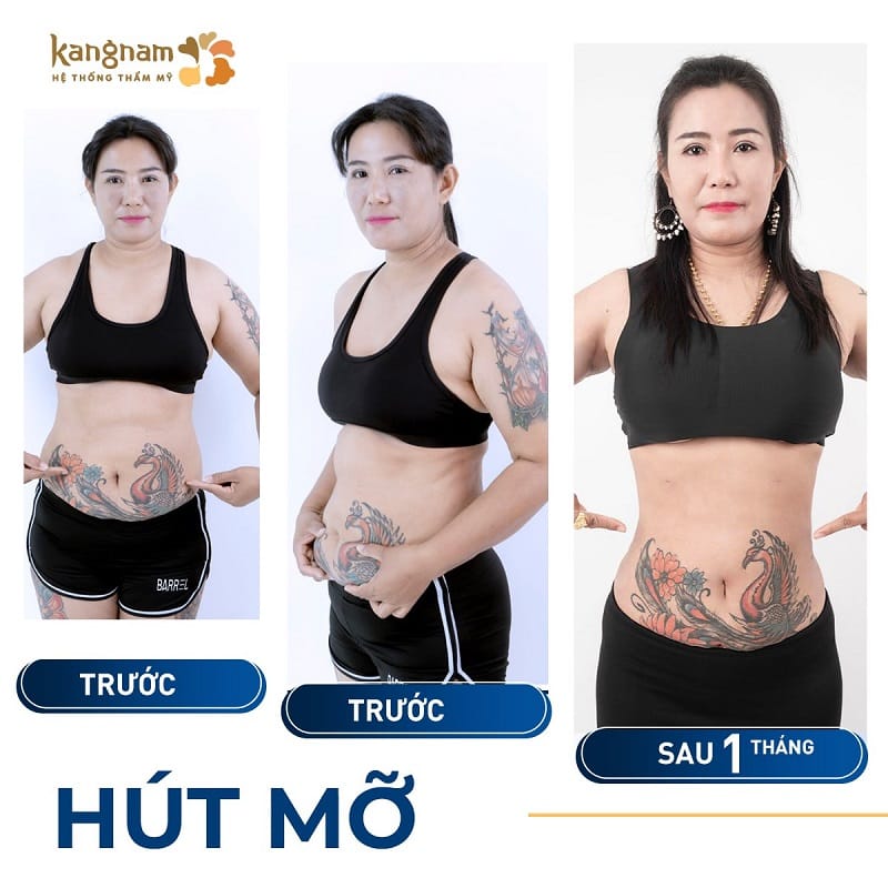 Kết quả vùng bụng ổn định sau 1 tháng