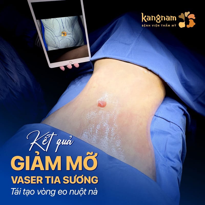 Công nghệ hút mỡ Vaser hiện đại giúp kết quả nhanh ổn định