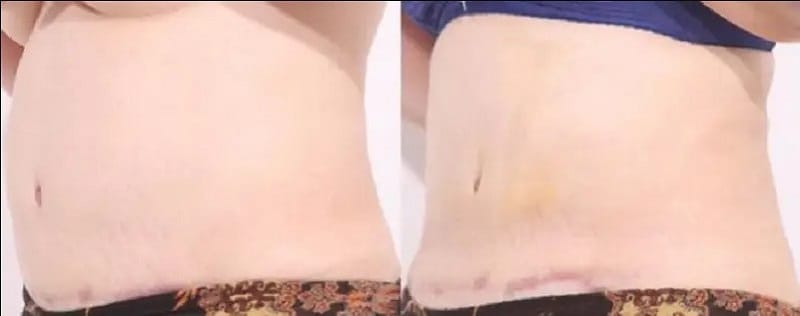 Vùng hút mỡ để lại sẹo khi không được thực hiện sai kỹ thuật