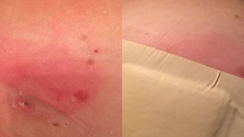 Hoại tử vùng hút mỡ là biến chứng nguy hiểm