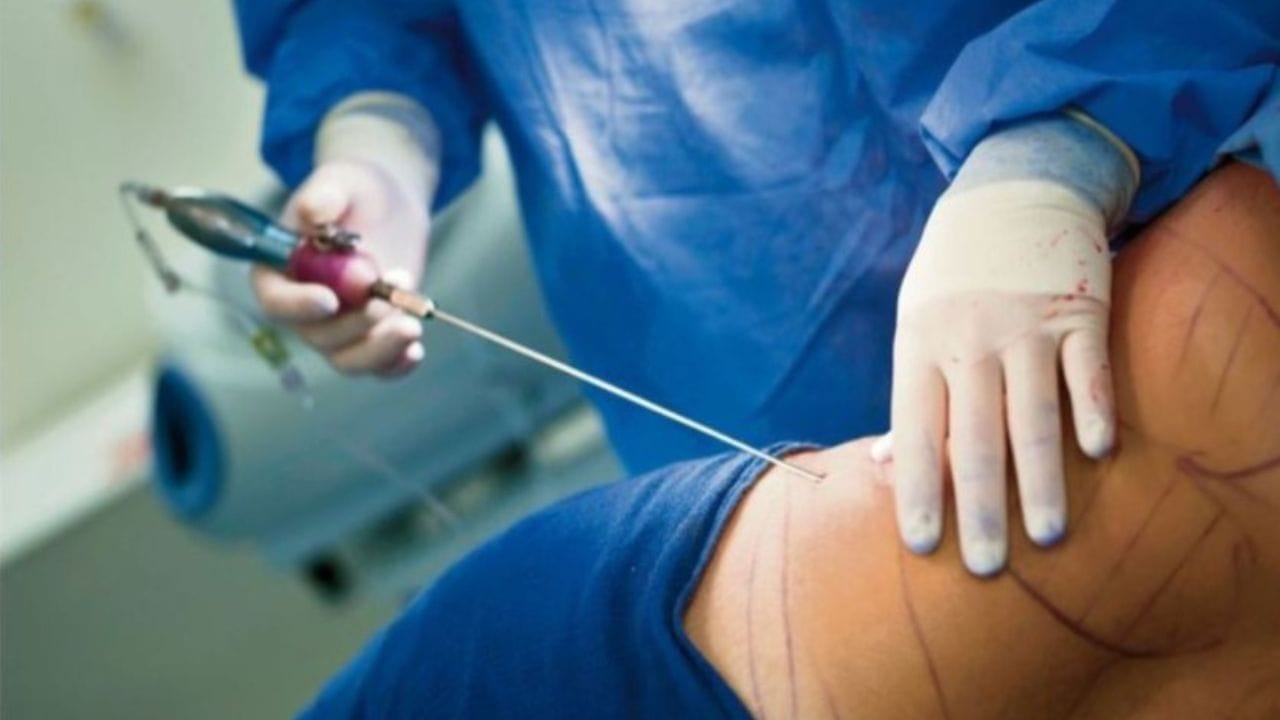 Hút mỡ có để lại di chứng gì không? cần lưu ý điều gì