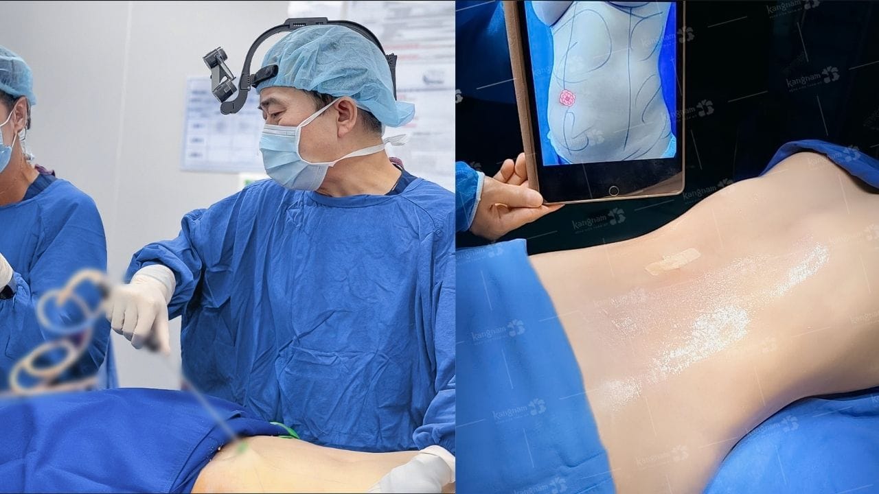 Hút mỡ có hại cho sức khỏe không? Có gây biến chứng không